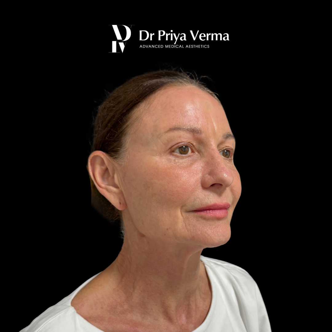 After AN Endolift lower face and neck