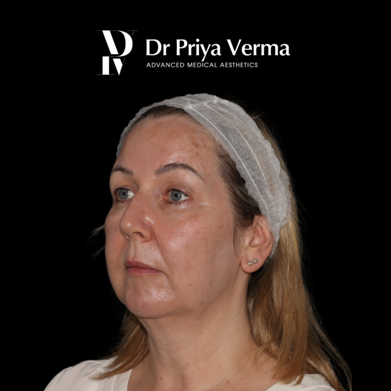 After AT Endolift and microdroplet filler with laser resurfacing