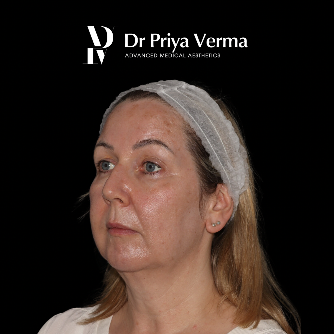 After AT Endolift and microdroplet filler with laser resurfacing