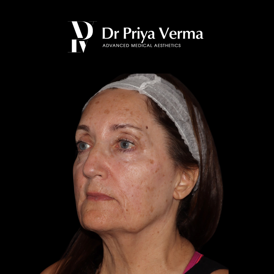 After DD Endolift, filler, ablative laser