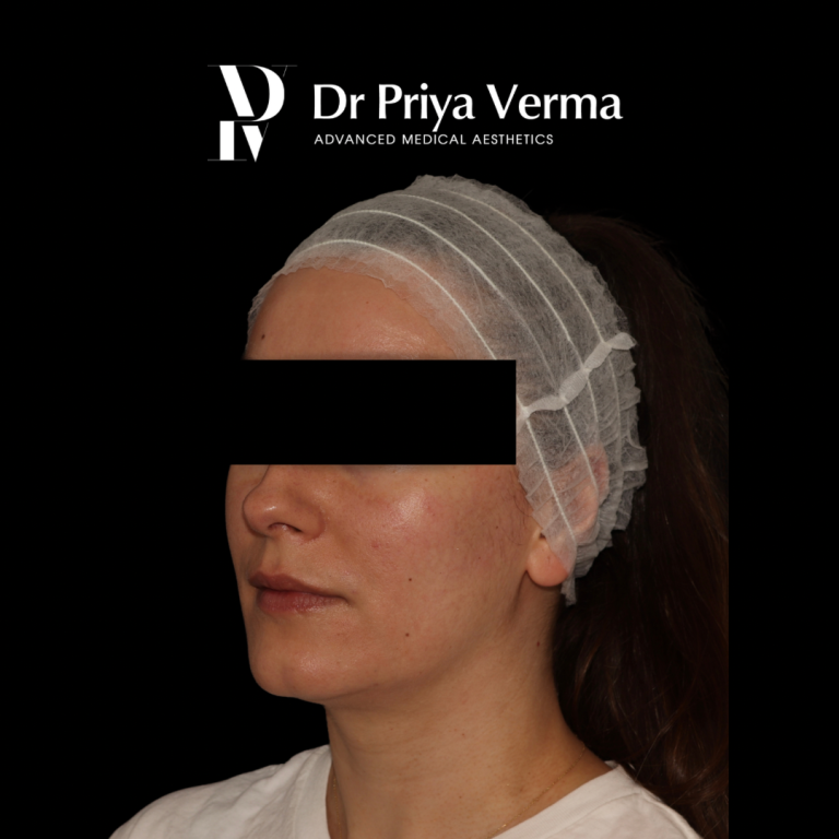 After DD Endolift jawline