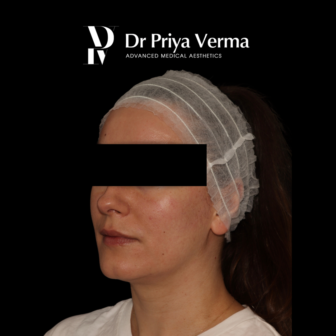 After DD Endolift jawline