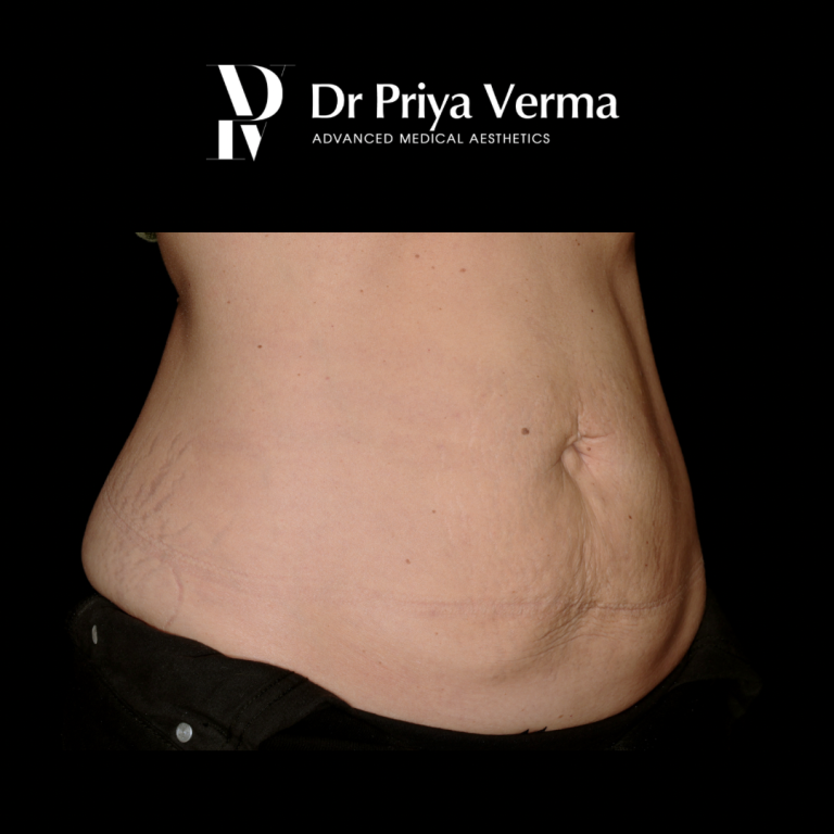 After FE Endo and Polys Abdo