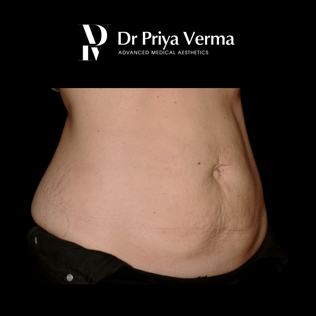 After FE Endo and Polys Abdo