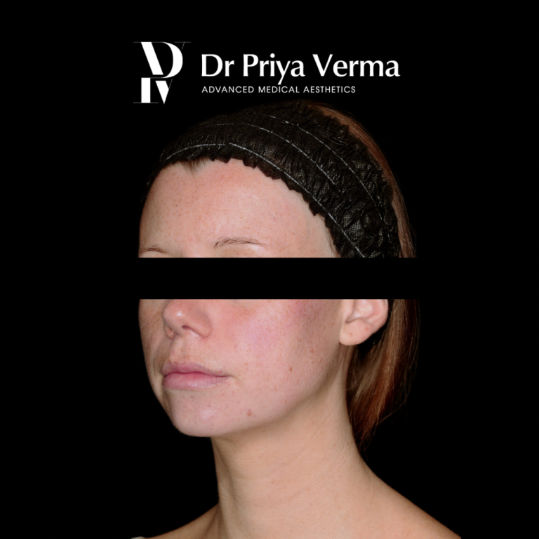 After HB Endolift and microdroplet filler