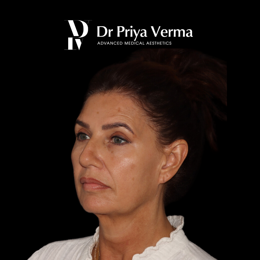 After KB Endolift and micro-droplet filler