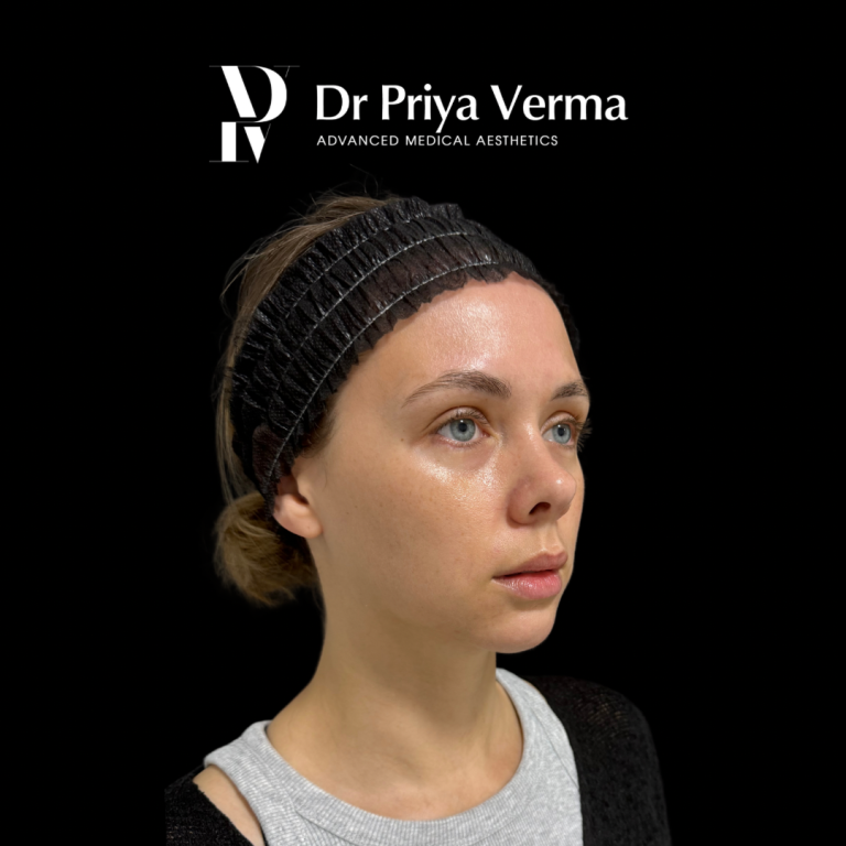 After NT Endolift and microdroplet filler