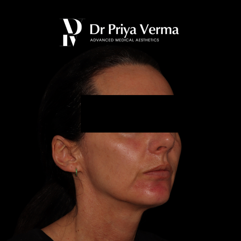 After RF Dermal Fillers cheek chin jawline