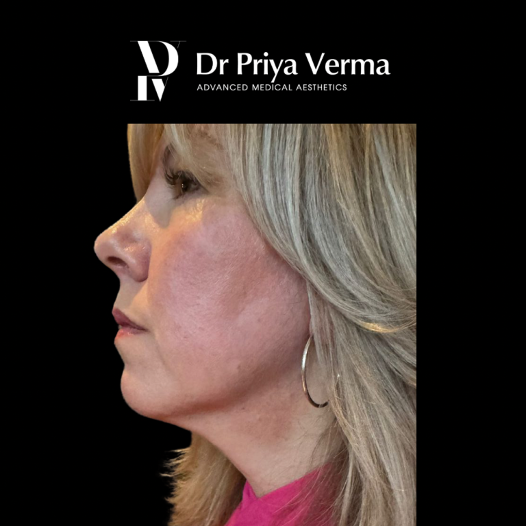 After RM Endolift Lower face and neck