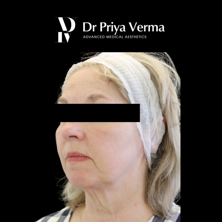 After VG Endolift malar, lower face, neck
