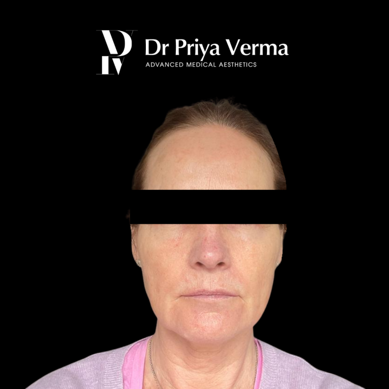 After endolift lower face and neck and filler