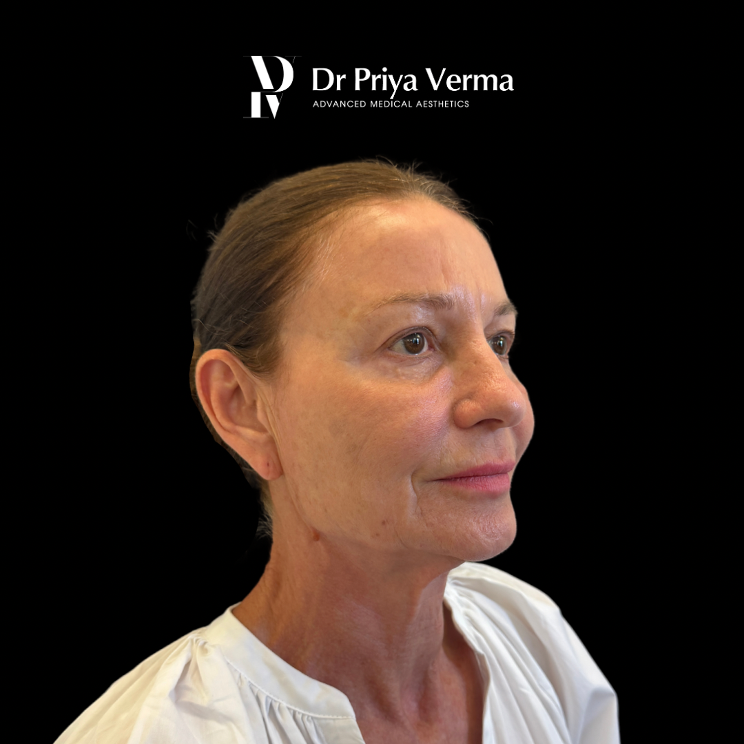 Before AN Endolift lower face and neck