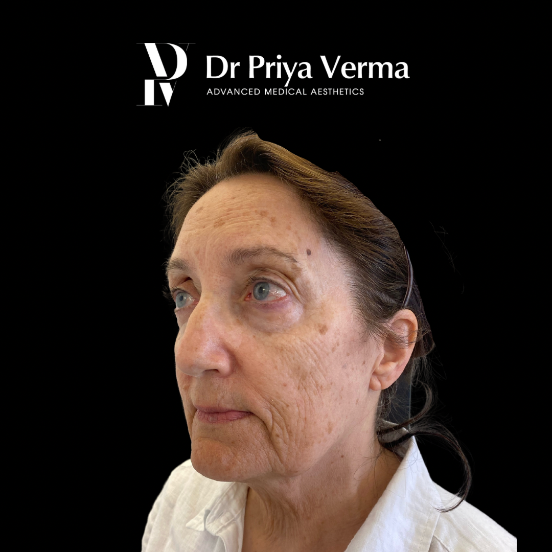 Before DD Endolift, filler, ablative laser