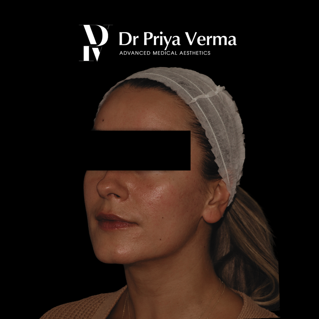 Before DD Endolift jawline