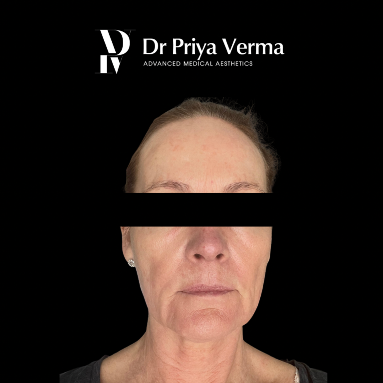 Before Endolift lower face and Filler