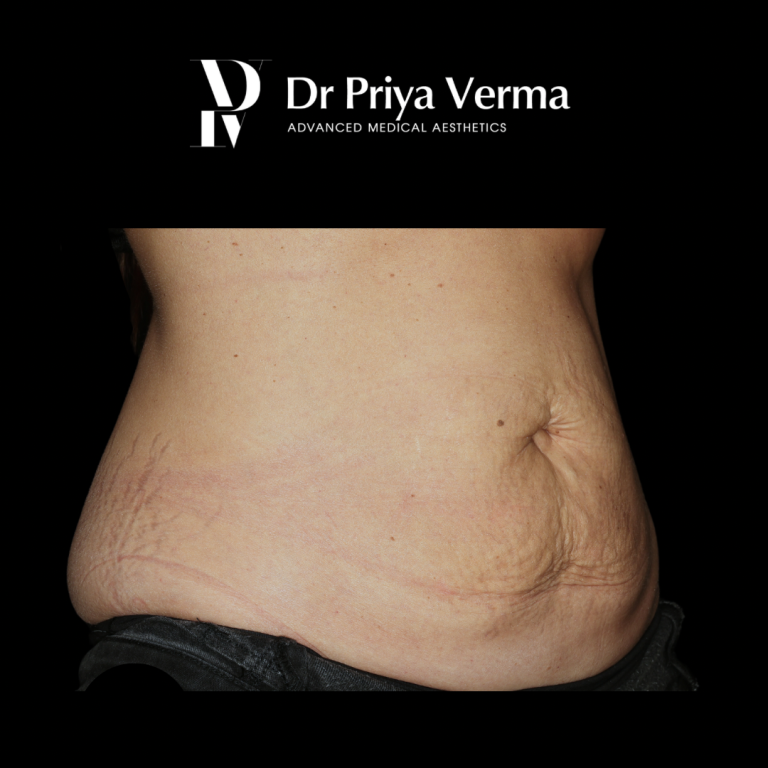 Before FE Endo and Polys Abdo