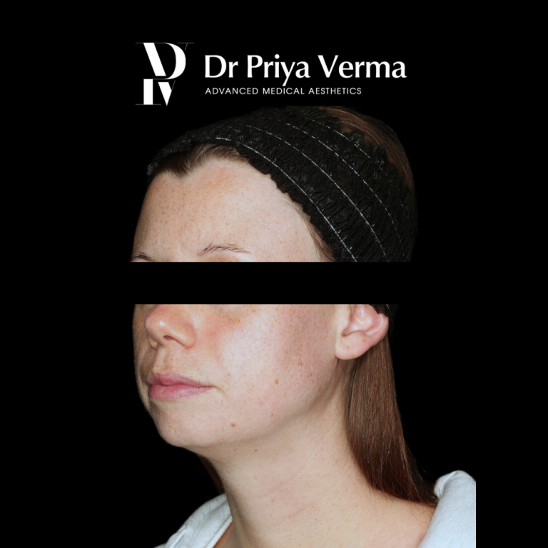 Before HB Endolift and microdroplet filler