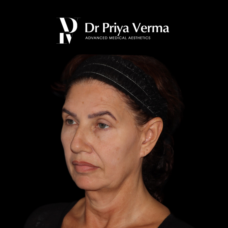 Before KB Endolift and micro-droplet filler