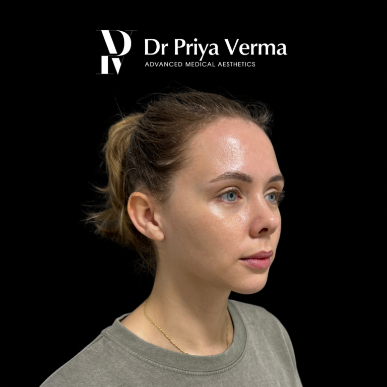 Before NT Endolift and microdroplet filler