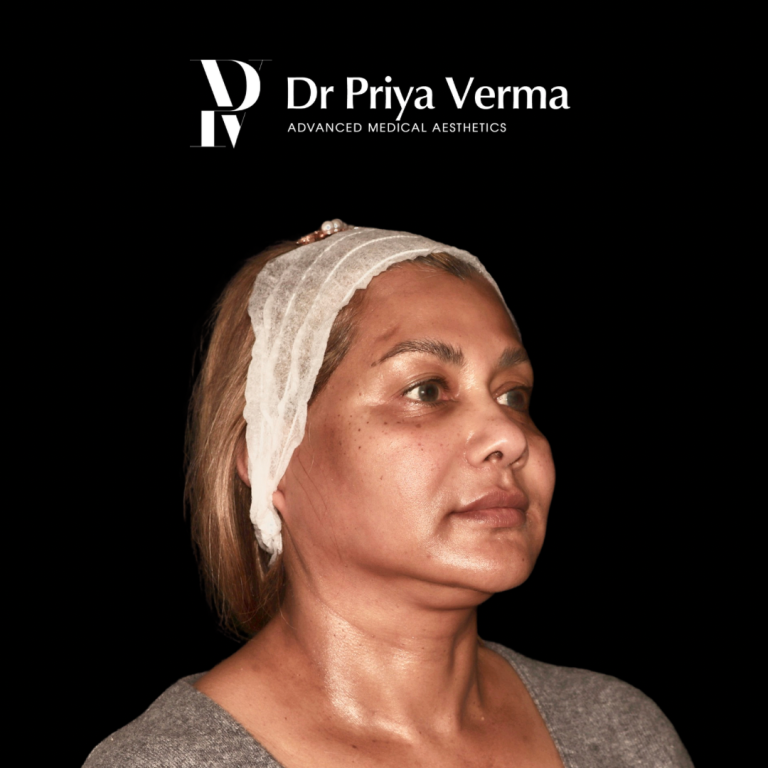 Before QS Endolift lower face and neck