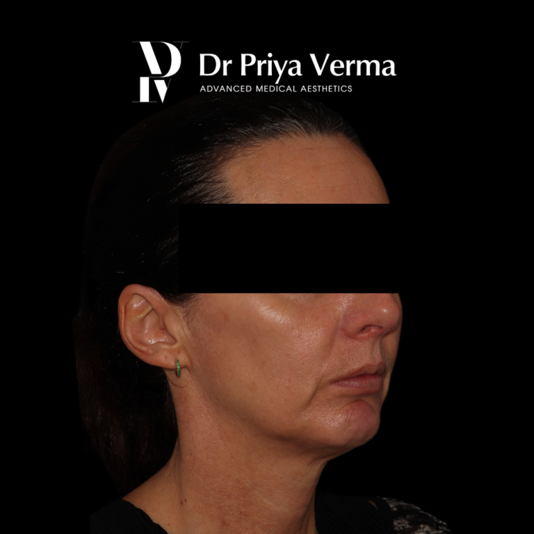 Before RF Dermal Fillers cheek chin jawline