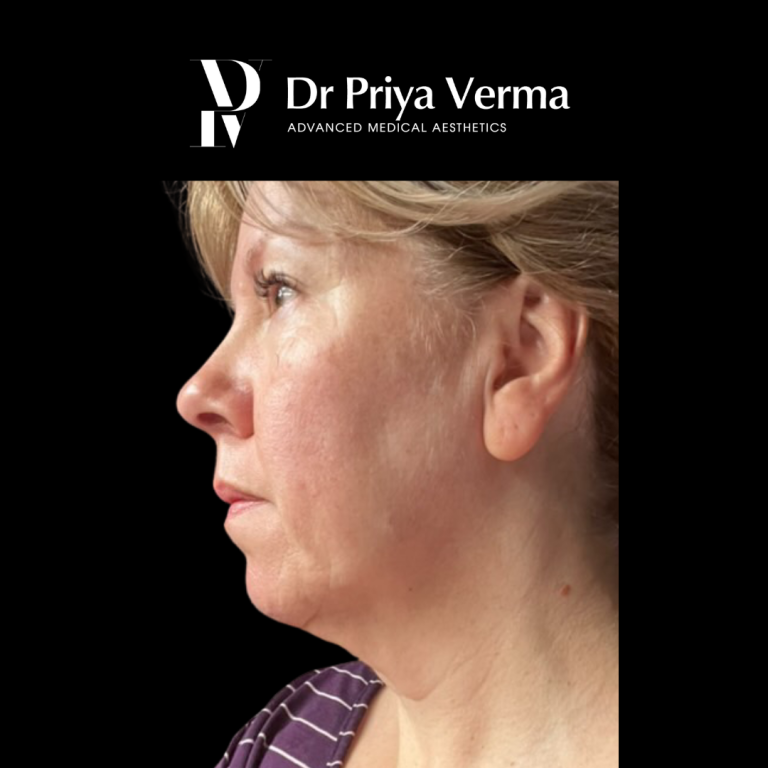 Before RM Endolift Lower face and neck