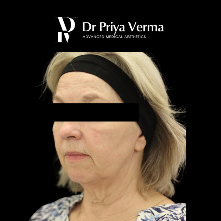 Before VG Endolift malar, lower face, neck