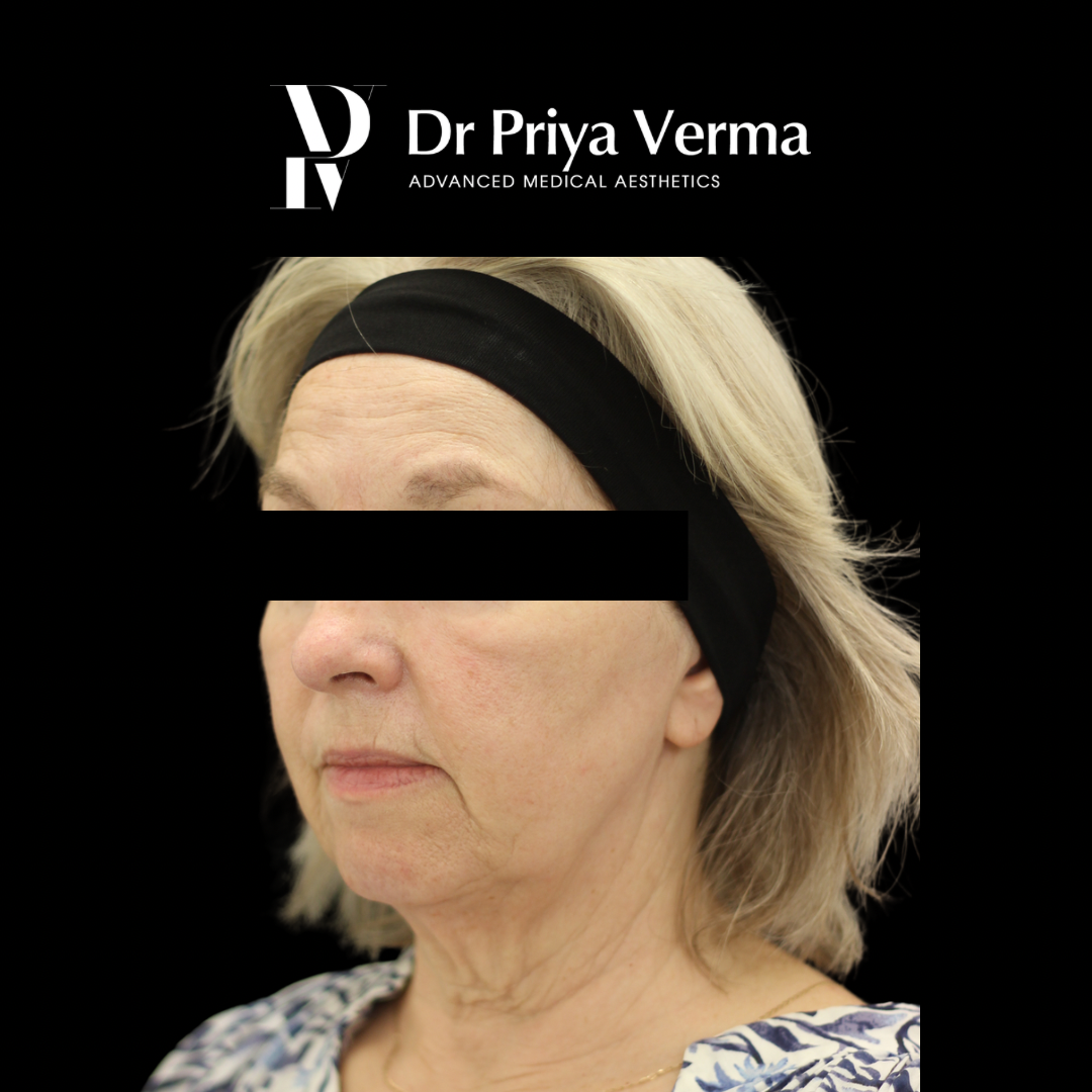 Before VG Endolift malar, lower face, neck