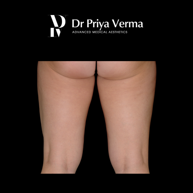 Endolift Thigh After