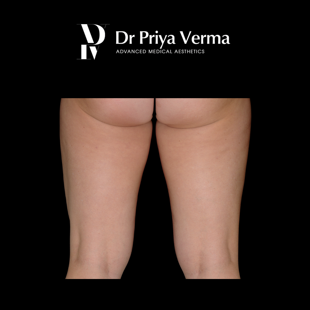 Endolift Thigh After