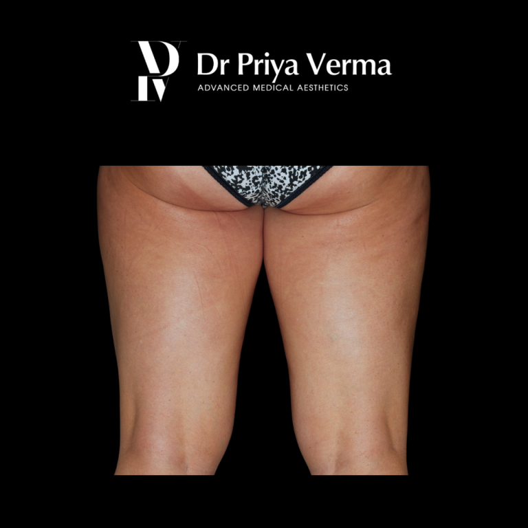 Endolift Thigh Before