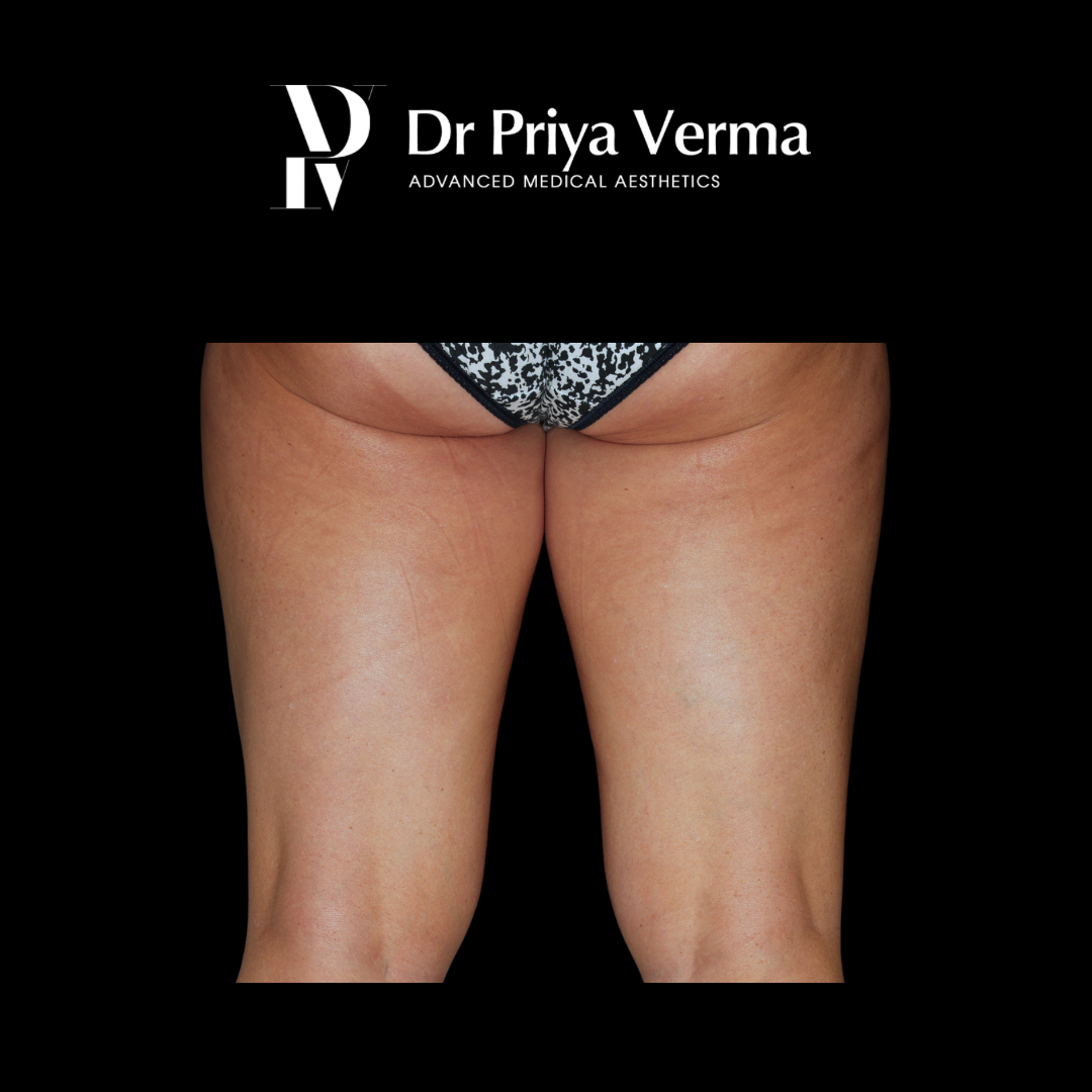 Endolift Thigh Before